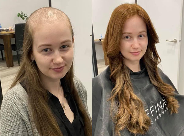 Hair Solutions for Trichotillomania