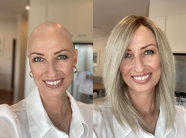 Hair Solutions for Cancer Patients
