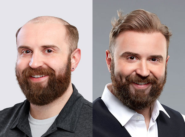 Hair Solutions for Men