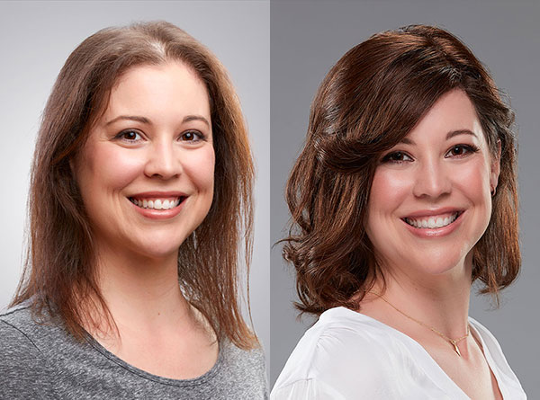 Hair Solutions for Thinning and Receding Hair